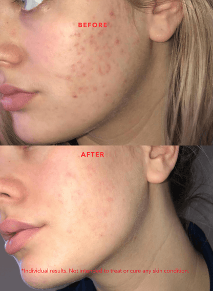 02A | ACNE SPOT TREATMENT